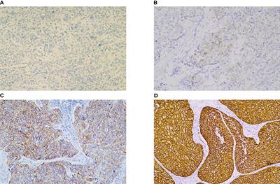 The values of HER-2 expression in the non-muscle-invasive bladder cancer: a retrospective clinical study